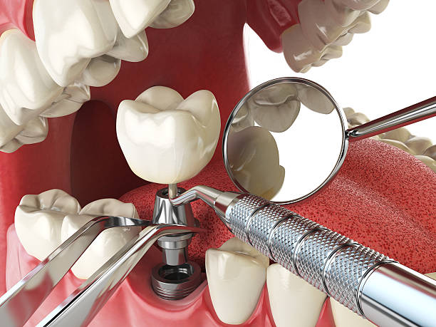 Best Emergency Root Canal Treatment in Sweetwater, FL